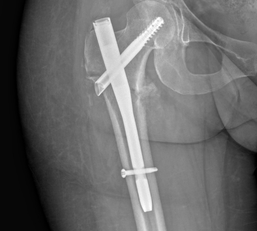 An x-ray of Erbe's hip.